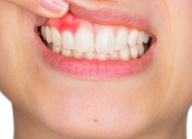 歯茎がプクっと腫れる原因は何ですか？