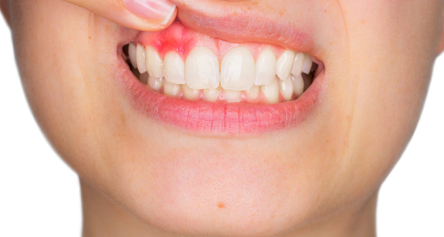 歯茎がプクっと腫れるとき、原因は何ですか？