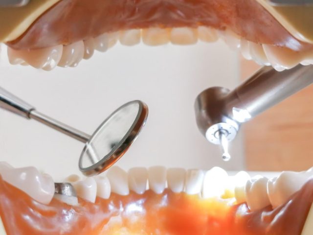 歯周病の種類について