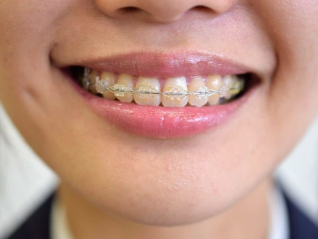 歯列矯正で保険適用になるのはどんな時？