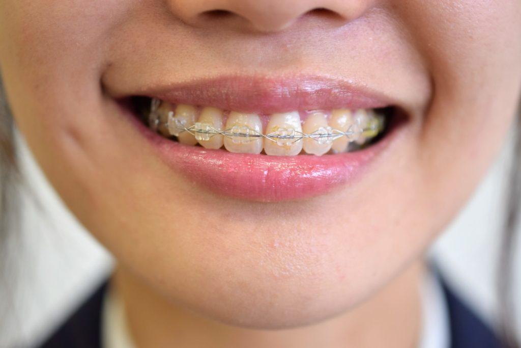 歯列矯正で保険適用になるのはどんな時？