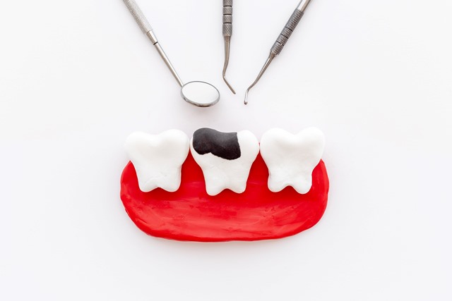 銀歯にはリスクがある？！～銀歯のメリット・デメリット～